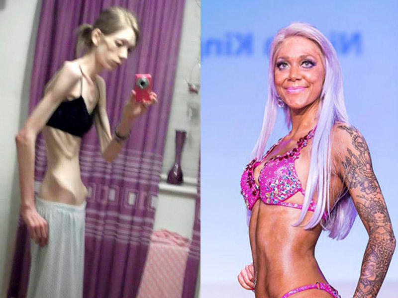 Anoreksiya xəstəsi gözəllik müsabiqəsində birinci oldu - FOTO