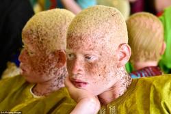 Bu gün albinoslar günüdür - FOTO