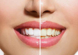 Dişlərin saralmasının əsas 9 səbəbi