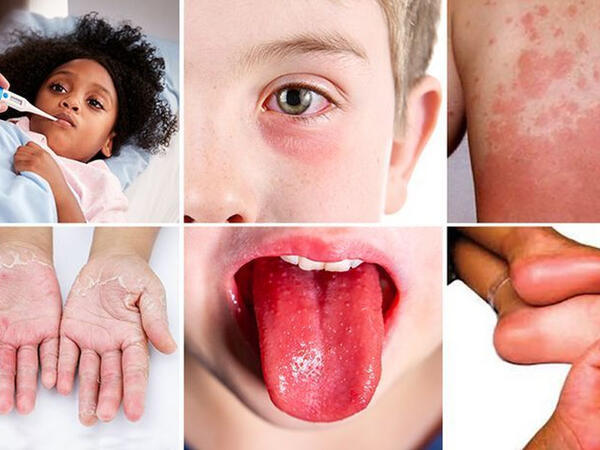 Uşaqlarda multisistemli iltihab sindromu - İnfeksiiyalardan <span class="color_red">sonra baş qaldırır</span>