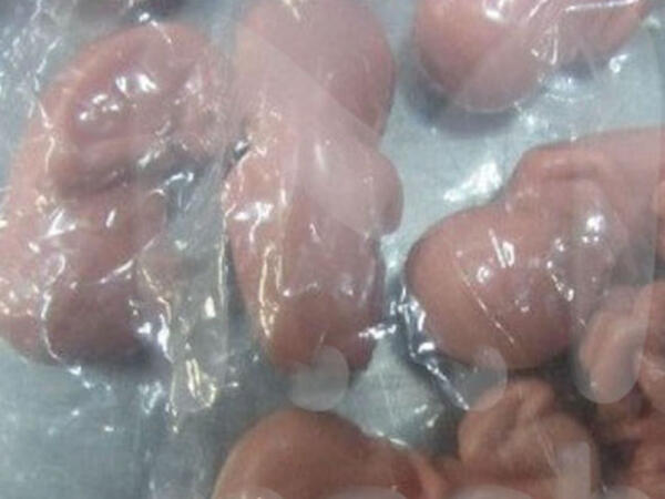 Qadının çantasından yüzlərlə insan embrionu tapıldı - FOTO