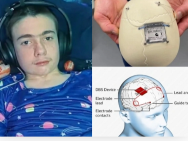 Yeniyetmənin beyninə implant yerləşdirildi