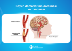 Bu müalicə də icbari tibbi sığortaya daxildir